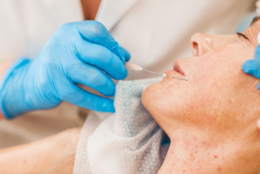 Why Thread Lifts Are Popular in Pompano Beach