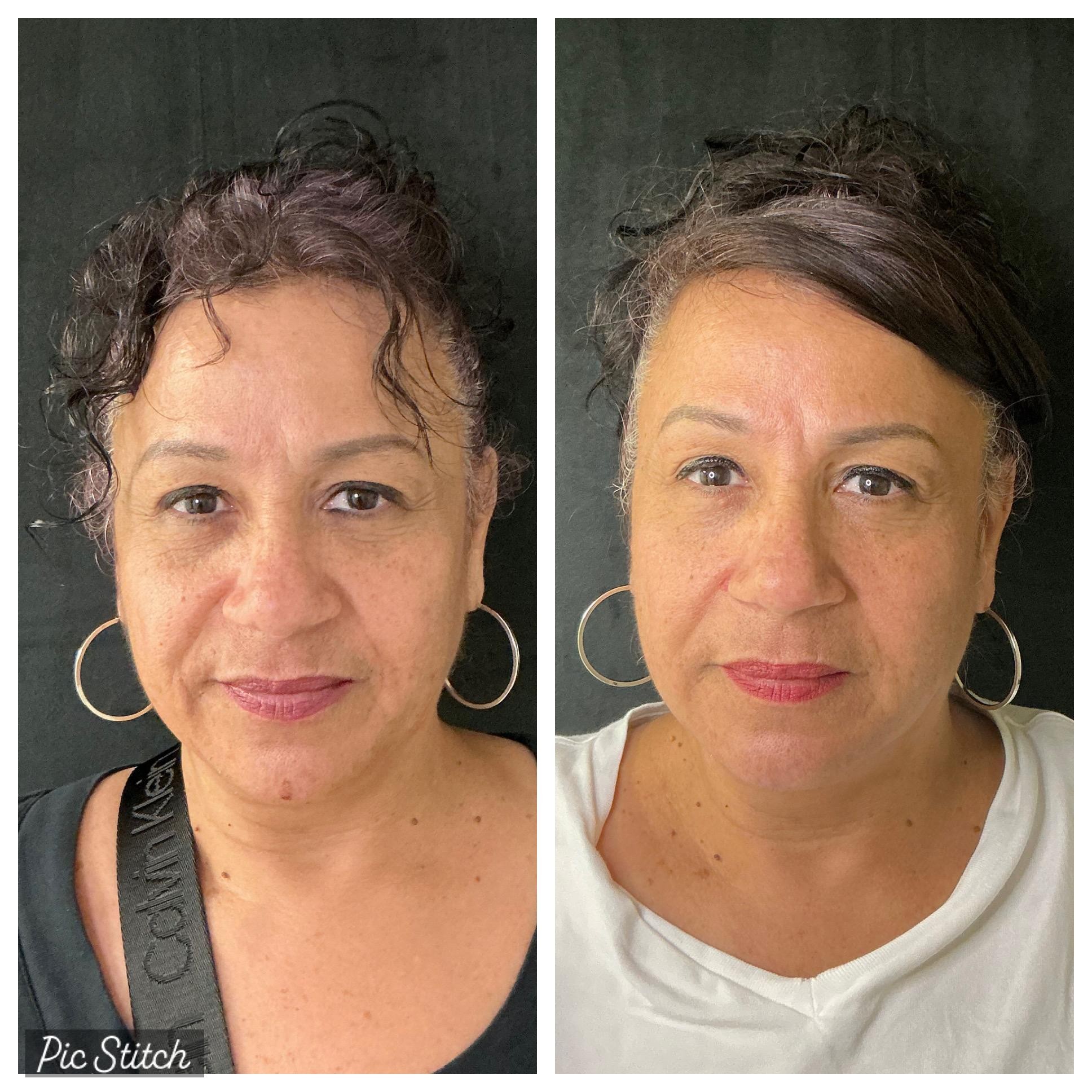 co2-laser-skin-resurfacing-before-and-after-results1