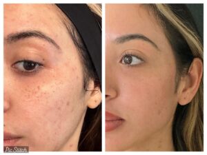 co2-laser-skin-resurfacing-before-and-after-results2
