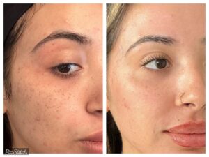 co2-laser-skin-resurfacing-before-and-after-results4