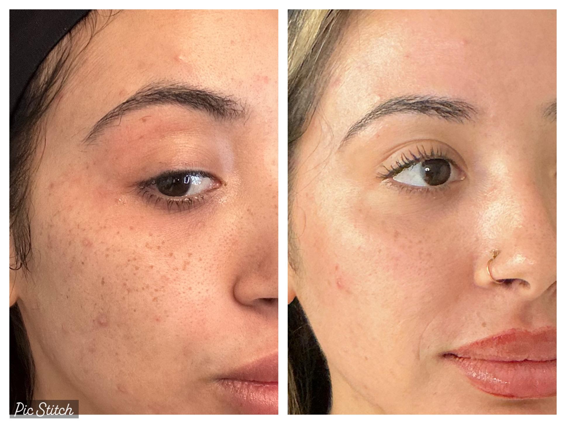 co2-laser-skin-resurfacing-before-and-after-results4