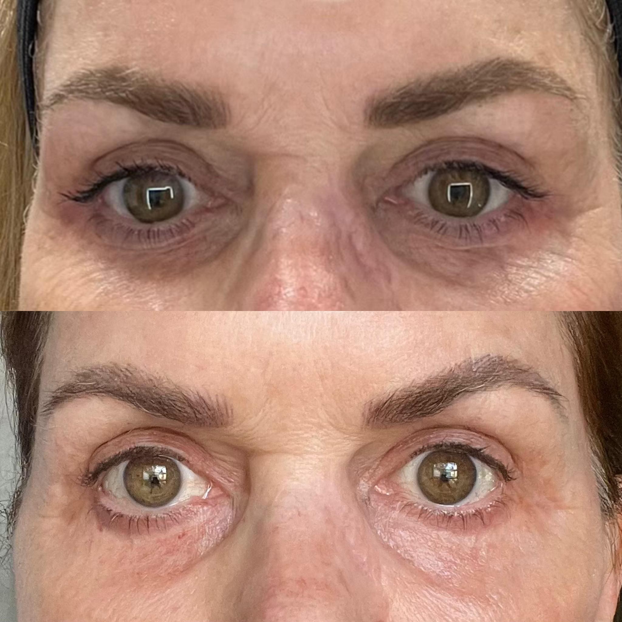 co2-laser-skin-resurfacing-before-and-after-results5