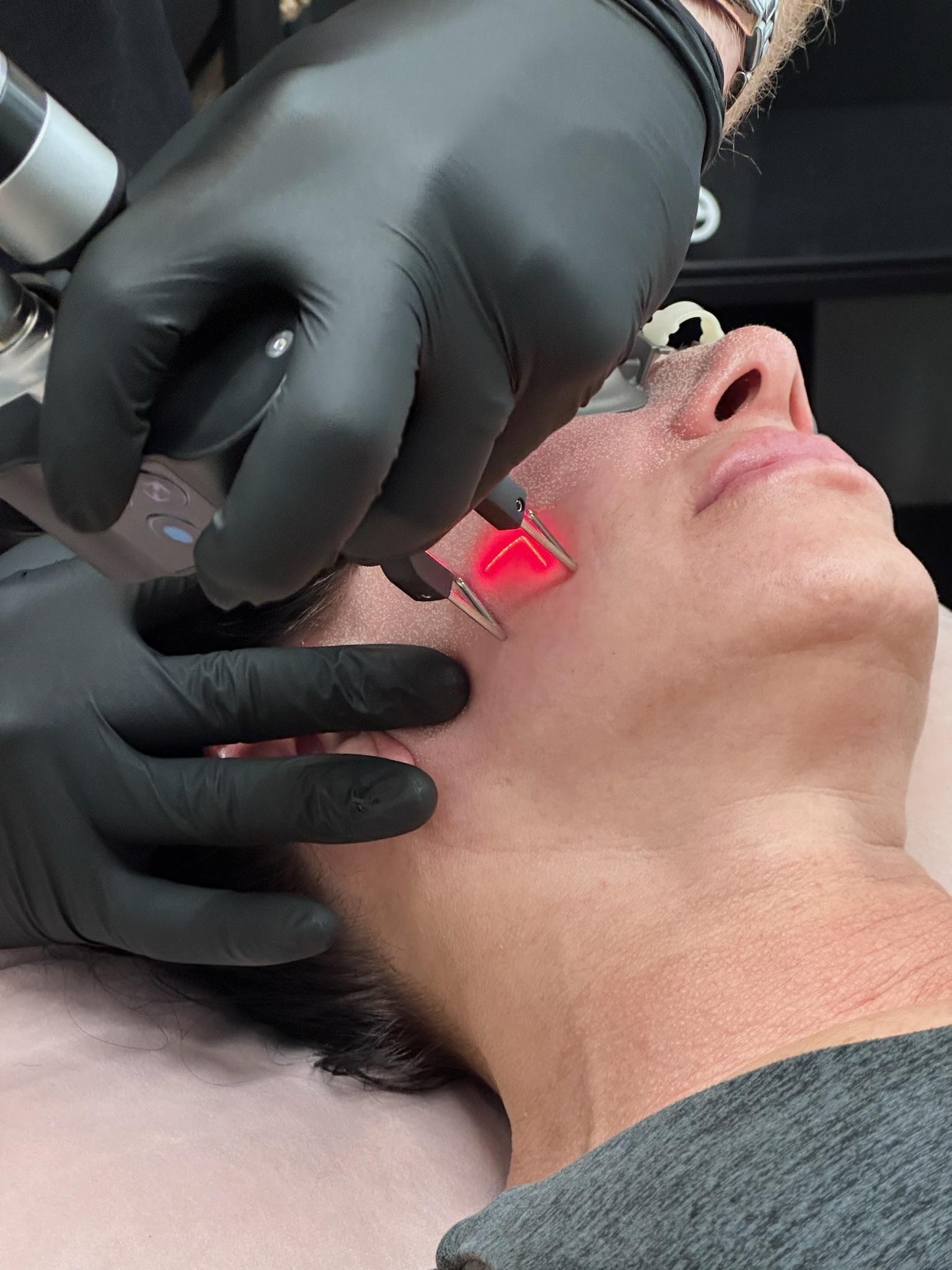 CO2 Laser Skin Resurfacing Guide in Pompano Beach