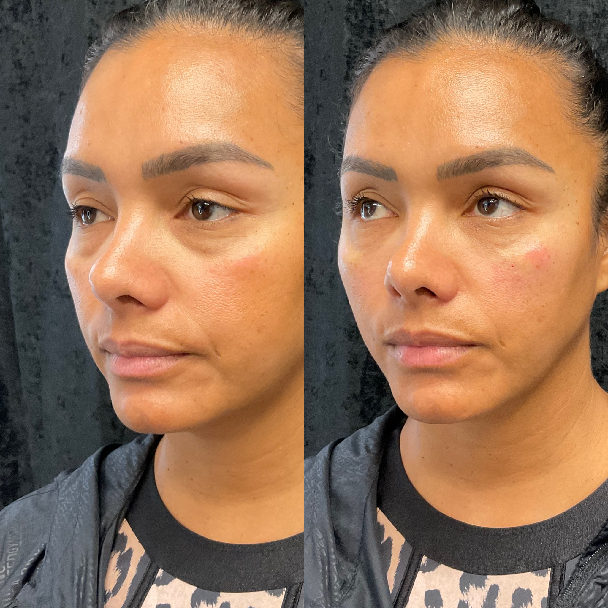 How Under-Eye Fillers Work