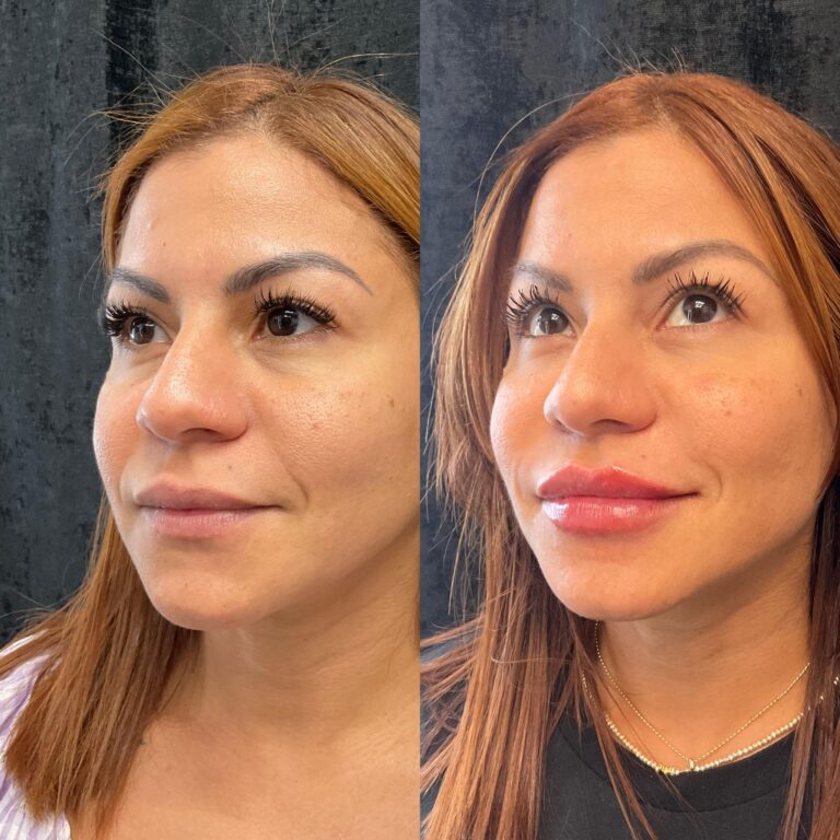 Facial Balancing with Dermal Fillers in Pompano Beach, FL