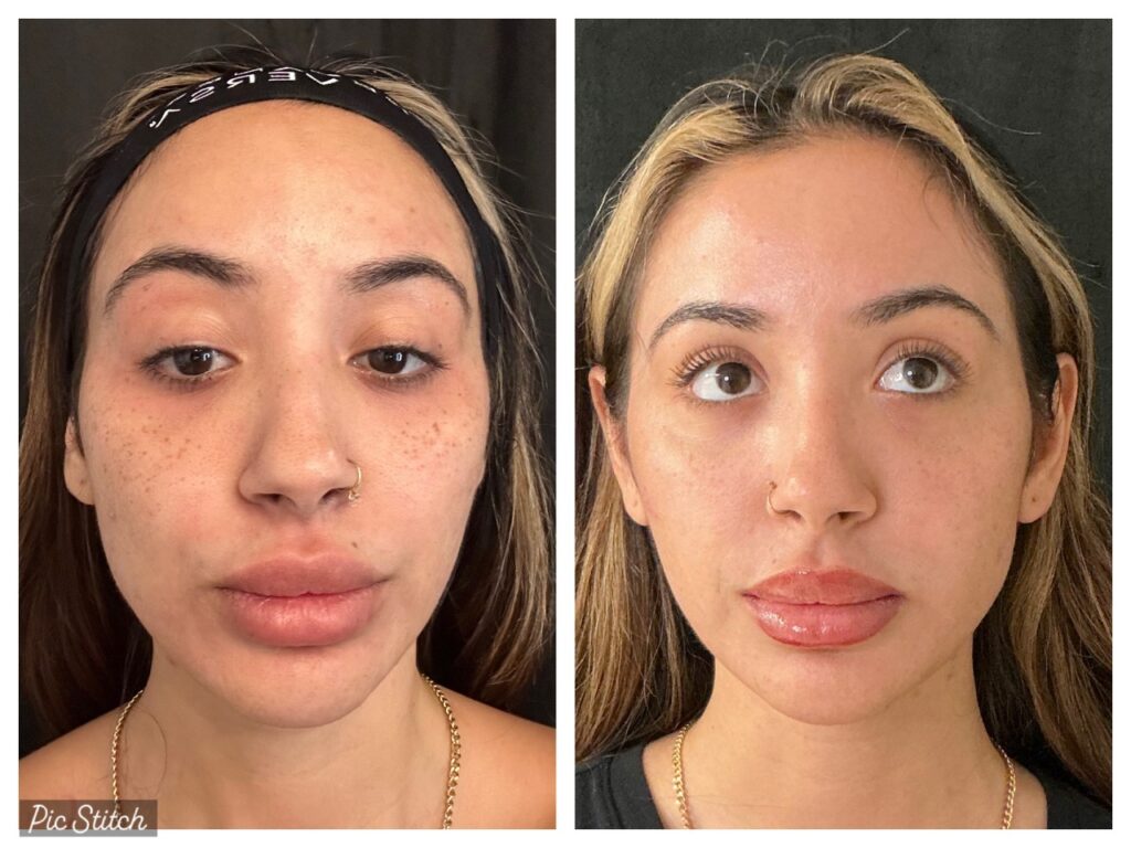 Benefits of Laser Skin Rejuvenation