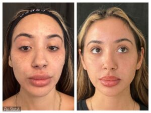 Benefits of Laser Skin Rejuvenation