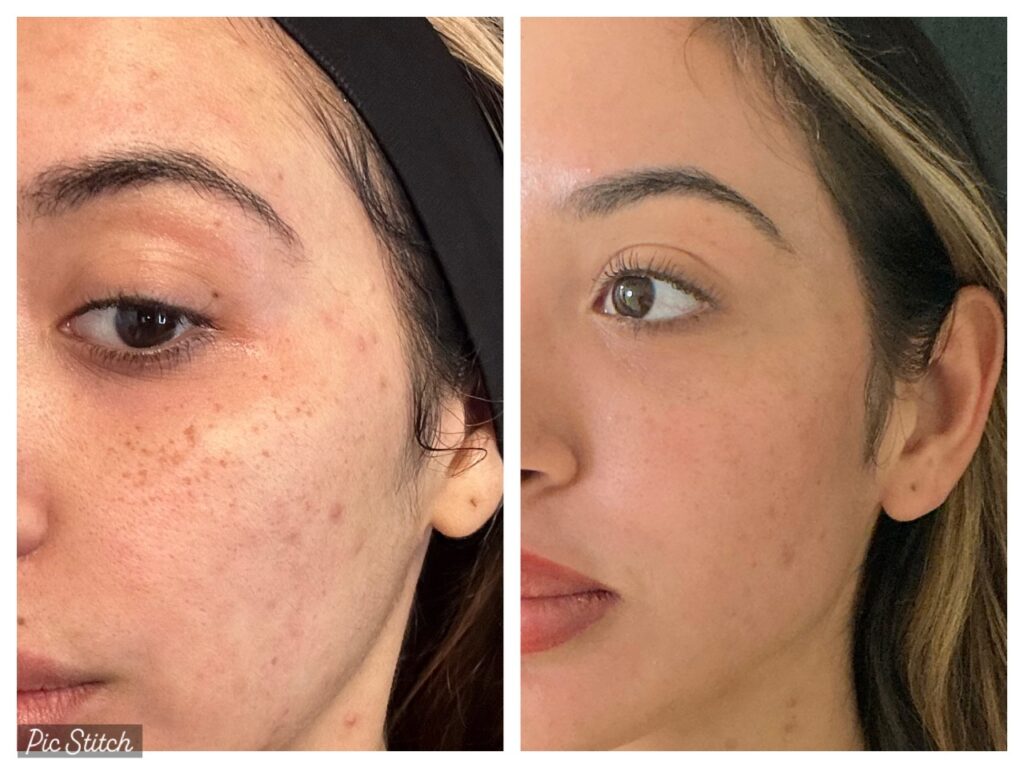 Is Laser Skin Rejuvenation Worth It in Pompano Beach, FL?
