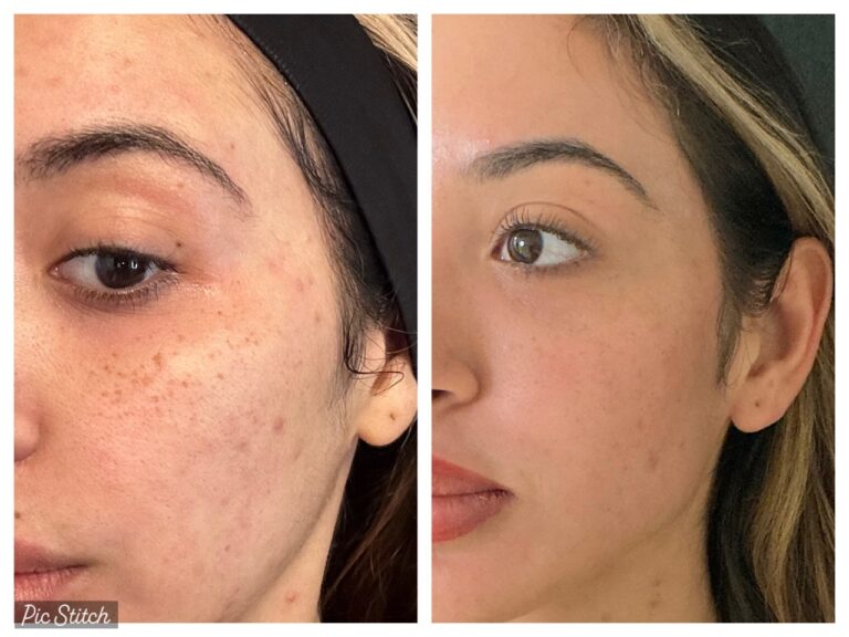 Is Laser Skin Rejuvenation Worth It in Pompano Beach, FL?