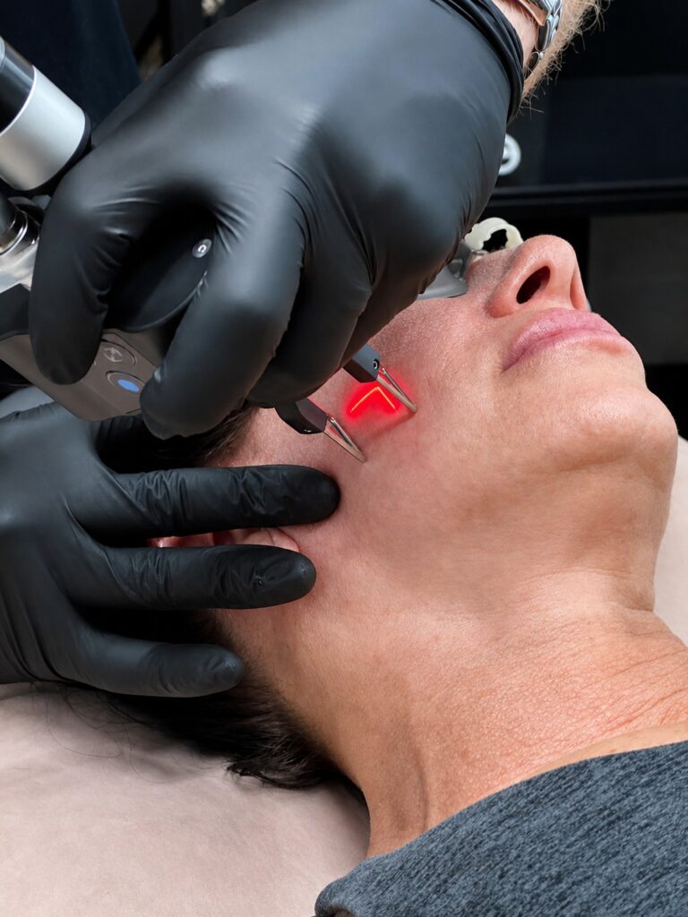 Acne Scar Treatment Options at Icon Aesthetics & Wellness