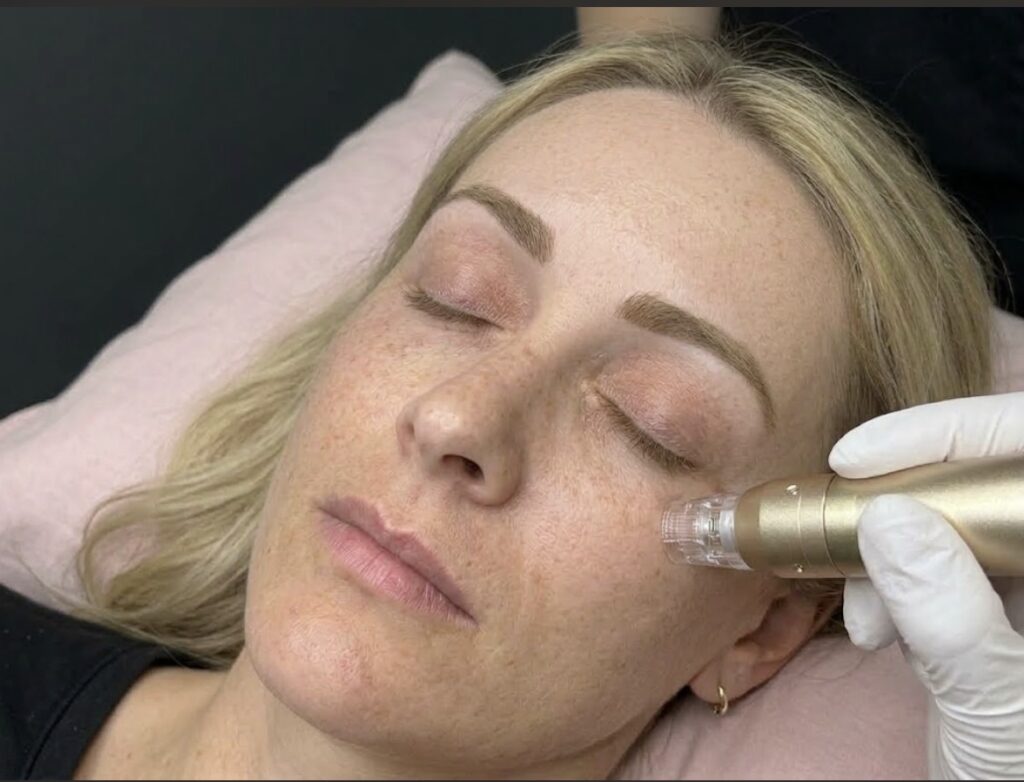 RF Microneedling Downtime and Results Timeline